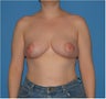 Breast Reduction
