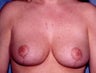Breast Reduction