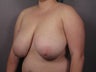 Breast Reduction