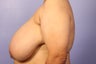 Breast Reduction