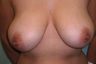 Breast Reduction