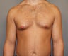 Breast Reduction