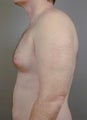 Breast Reduction