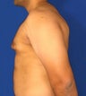 Breast Reduction
