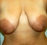 Breast Reduction