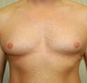 Male Breast Reduction