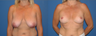 Breast reduction/breast lift
