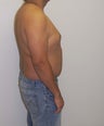 Gynecomastia