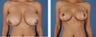 Breast Reduction