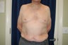 Gynecomastia with Liposuction