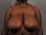 Breast Reduction