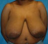 Breast Reduction