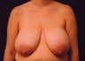 Breast Reduction