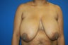 Breast Reduction