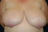 Breast Reduction