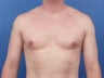 Male Breast Reduction