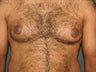 Male Breast Reduction (Gynecomastia)