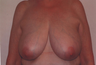 Breast Reduction