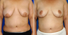 Breast Reduction