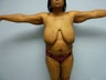 Breast Reduction