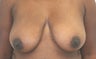 Breast Reduction