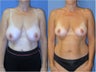 Breast Reduction