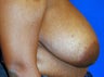 Breast Reduction