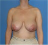 Breast Reduction