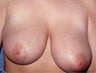Breast Reduction