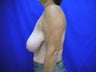 Breast Reduction