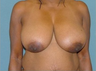 Breast Reduction