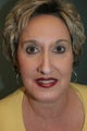 Brow Lift
