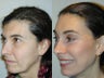 Full Facelift - Browlift, upper and  lower blepharoplasty, Lower Facelift
