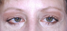 Brow Lift with lower blepharoplasty (lower eyelids)