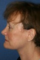 Brow Lift