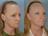 Endoscopic Browlift and Laser Resurfacing to lower eyelids