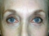 Upper Eyelid Ptosis Repair And Blepharoplasty; Lower Eyelid Blepharoplasty And Ectropion Repair; Endoscopic Brow Lift