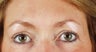 Brow Lift