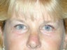 Endoscopic Brow Lift and Blepharoplasty