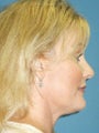 Endoscopic browlift, Upper and Lower Blepharoplasty, Liposuction of the Neck, Fat injections to the lips, Perioral Dermabrasion.