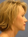  Endoscopic Browlift, Lower Blepharoplasty, Fat Injections to the Lips and Nasolabial Folds, Perioral Dermabrasion, and removal 