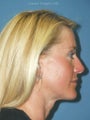  Coronal Browlift, Upper and Lower Blepharoplasty, Llp Augmentation with Alloderm® graft, Perioral Dermabrasion.  