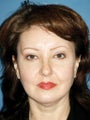 Endoscopic Browlift, Upper and Lower Blepharoplasty 