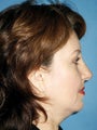  Endoscopic Browlift, Upper and Lower Blepharoplasty 