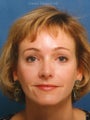 Endoscopic Browlift, Upper and Lower Blepharoplasty, Rhinoplasty with refinement of the nasal tip and dorsum