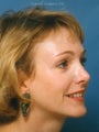  Endoscopic Browlift, Upper and Lower Blepharoplasty, Rhinoplasty with refinement of the nasal tip and dorsum. 