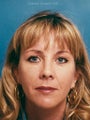 Endoscopic Browlift