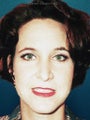  Endoscopic Browlift and Bilateral Upper Blepharoplasty 