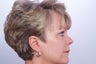Endoscopic Brow Lift