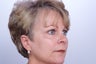 Endoscopic Brow Lift